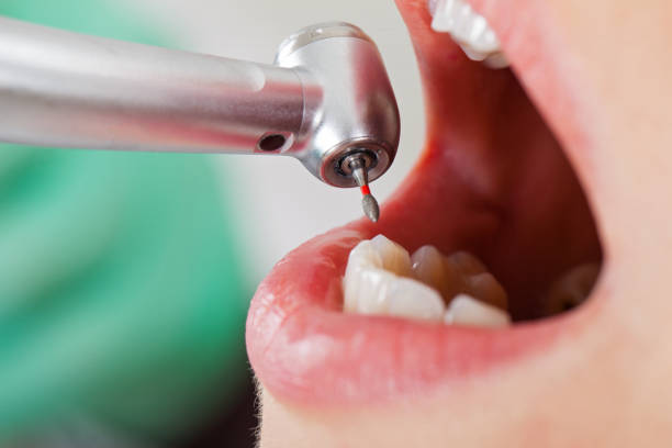 Best Emergency Root Canal Treatment in Manhattan, KS